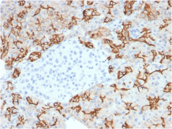 IHC-P analysis of human pancreatic carcinoma tissue using GTX17726 TACSTD2 antibody [TACSTD2/2153].