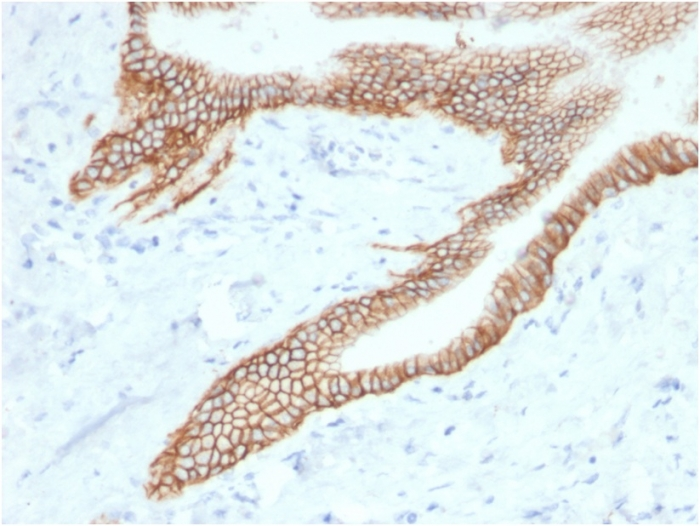 IHC-P analysis of human pancreatic carcinoma tissue using GTX17726 TACSTD2 antibody [TACSTD2/2153].