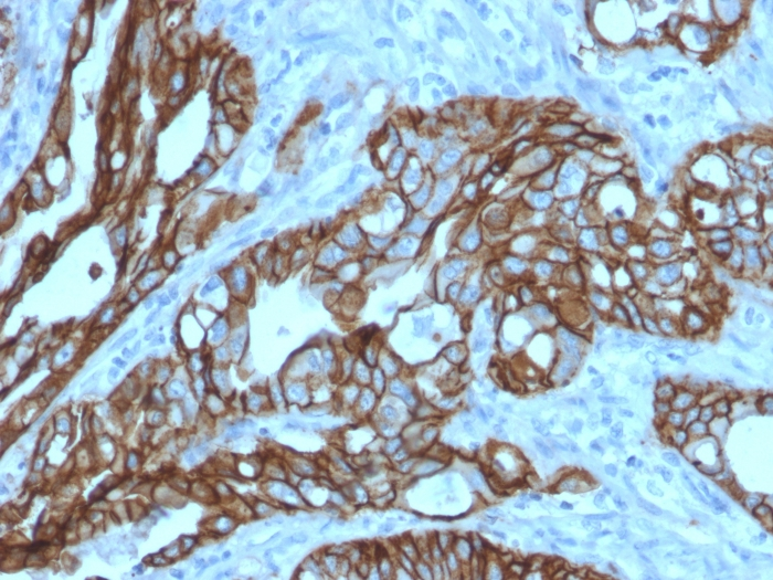 IHC-P analysis of human colon carcinoma tissue using GTX17741 TACSTD2 antibody [TACSTD2/2152].