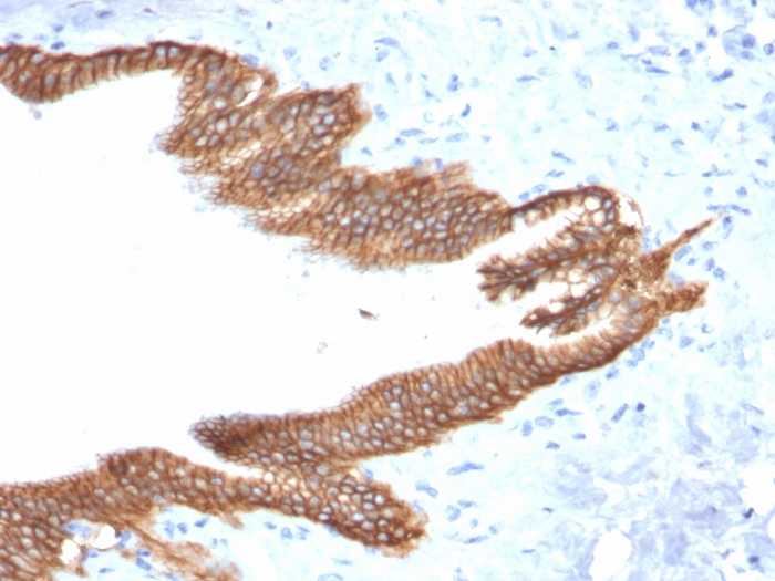 IHC-P analysis of human pancreatic carcinoma tissue using GTX17741 TACSTD2 antibody [TACSTD2/2152].
