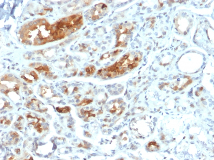 IHC-P analysis of human breast carcinoma tissue using GTX17743 Mammaglobin A antibody [MGB1/2000].