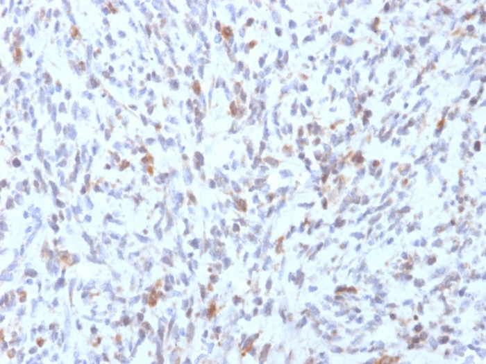 IHC-P analysis of human rhabdomyosarcoma tissue using GTX17751 MyoD1 antibody [rMYD712].