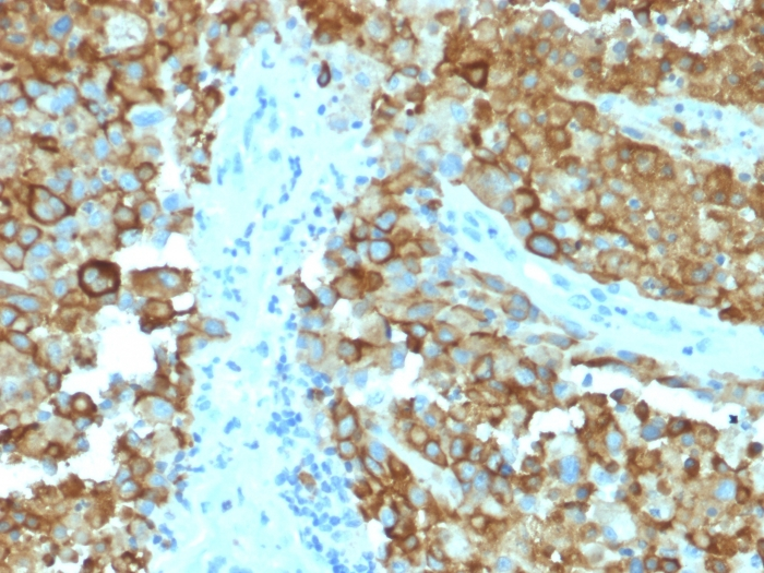 IHC-P analysis of human melanoma tissue using GTX17773 Melanoma gp100 antibody [PMEL/2038].