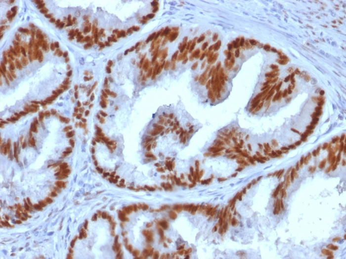 IHC-P analysis of human endometrial carcinoma tissue using GTX17904 Estrogen Receptor alpha antibody [ESR1/1935].