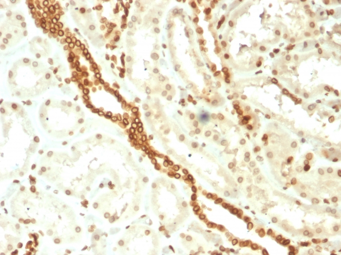 IHC-P analysis of human renal cell carcinoma tissue using GTX17952 Emerin antibody [EMD/2168].