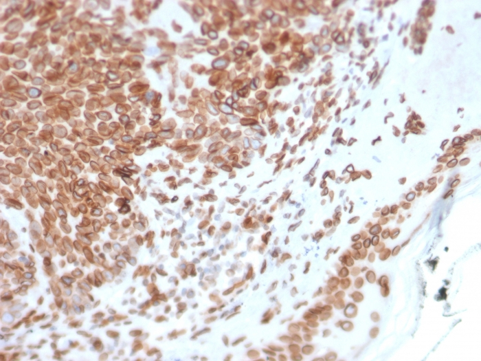 IHC-P analysis of human basal cell carcinoma tissue using GTX17952 Emerin antibody [EMD/2168].