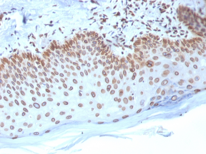 IHC-P analysis of human breast carcinoma tissue using GTX17952 Emerin antibody [EMD/2168].