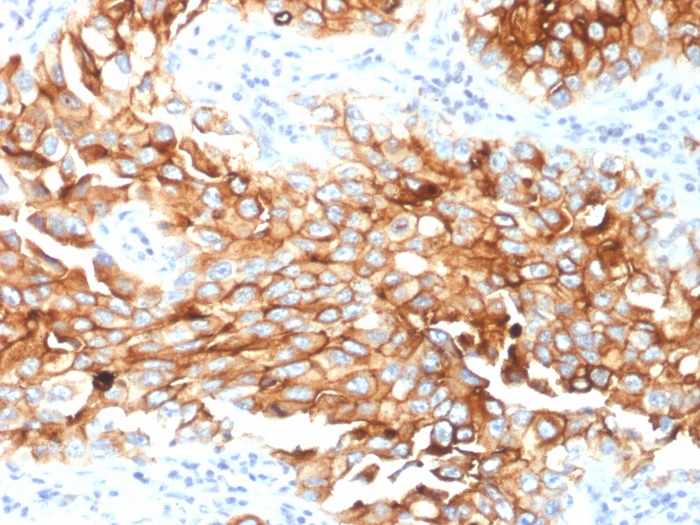 IHC-P analysis of human lung mesothelioma tissue using GTX17953 Mesothelin antibody [MSLN/2131].