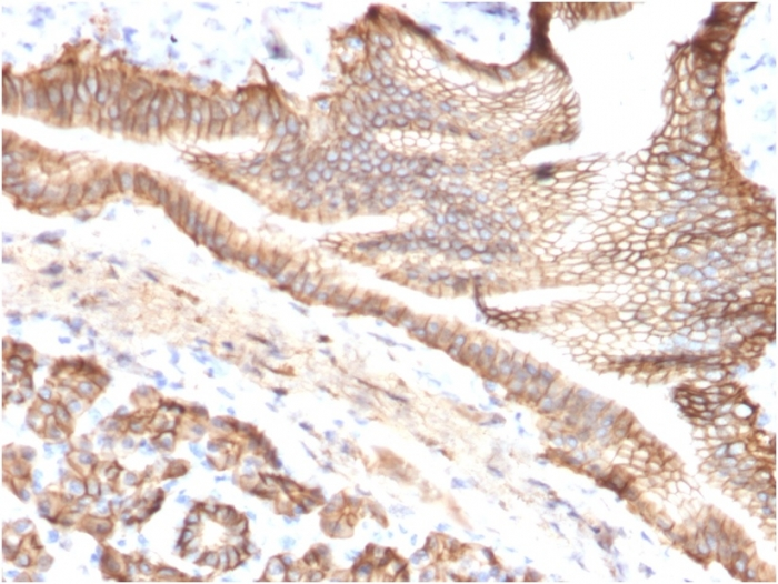 IHC-P analysis of human pancreatic carcinoma tissue using GTX17970 TACSTD2 antibody [TACSTD2/2151].