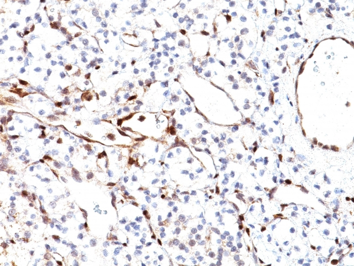 IHC-P analysis of human renal cell carcinoma tissue using GTX17980 PTEN antibody [PTEN/2110].