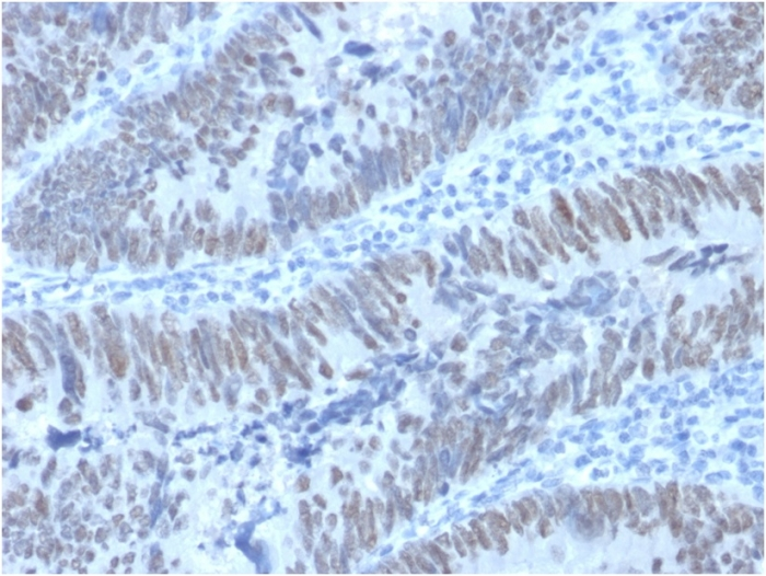 IHC-P analysis of human colon carcinoma tissue using GTX18049 CDX2 antibody [PCRP-CDX2-1A3].