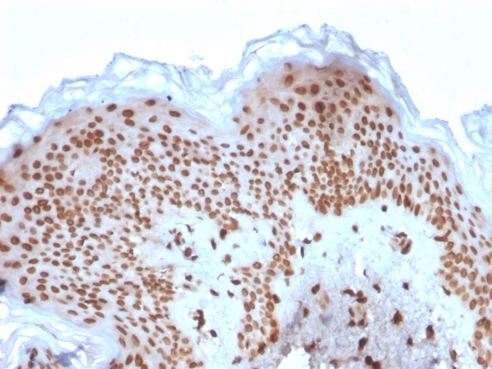 IHC-P analysis of human basal cell carcinoma tissue using GTX18054 Emerin antibody [EMD/2167].