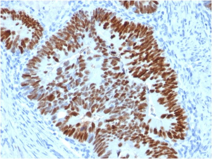 IHC-P analysis of human colon carcinoma tissue using GTX18125 p53 antibody [PCRP-TP53-2A10].
