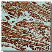 IHC-P analysis of human leiomyoma tissue using GTX18147 alpha Smooth Muscle Actin antibody [0.N.5].