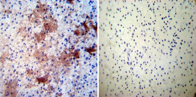 IHC-P analysis of human glioma tissue using GTX19378 CRMP5 antibody [CR-1]. Left : Primary antibody Right : Negative control without primary antibody Antigen retrieval : heat induced antigen retrieval was performed using 10mM sodium citrate (pH6.0) buffer, microwaved for 8-15 minutes Dilution : 1:50