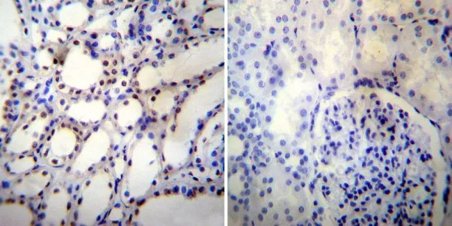 IHC-P analysis of human bladder carcinoma tissue using GTX19407 p54nrb antibody.