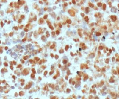 IHC-P analysis of human breast cancer xenograft tissue using GTX20194 APE1 antibody [13B8E5C2].