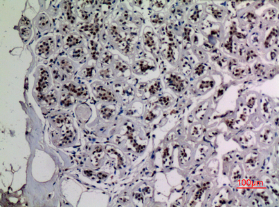 IHC-P analysis of human breast tissue using GTX20307 NFkB p65 (acetyl Lys218) antibody. Dilution : 1:100 IHC-P analysis of human breast tissue using GTX20307 NFkB p65 (acetyl Lys218) antibody. Dilution : 1:100