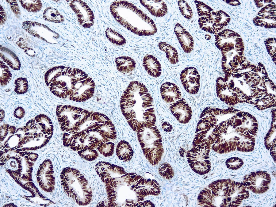 Formalin fixed paraffin embedded human colon carcinoma stained with p53 antibody (GTX20911).