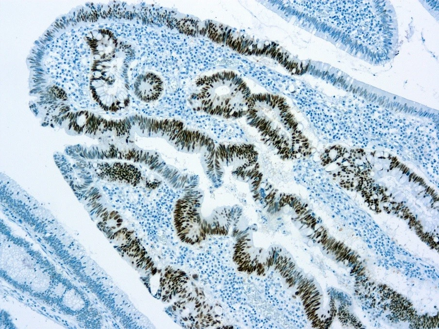 IHC-P analysis of human colon adenocarcinoma tissue using GTX20911 p53 antibody [DO-7] (ready-to-use) with GTX03609 Quatro Sol II 10X Tris-EDTA Buffer pH9.0 Kit.