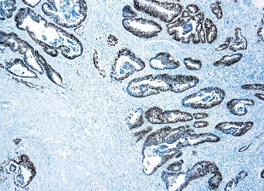 IHC-P analysis of human colon adenocarcinoma tissue using GTX20911 p53 antibody [DO-7] (ready-to-use) with GTX03608 Quatro Sol I 10X Citrate Buffer pH6.0 Kit.