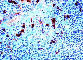 IHC-P analysis of human tonsil tissue using GTX20921 alpha 1 Antichymotrypsin antibody (ready-to-use). IHC-P analysis of human tonsil tissue using GTX20921 alpha 1 Antichymotrypsin antibody (ready-to-use).