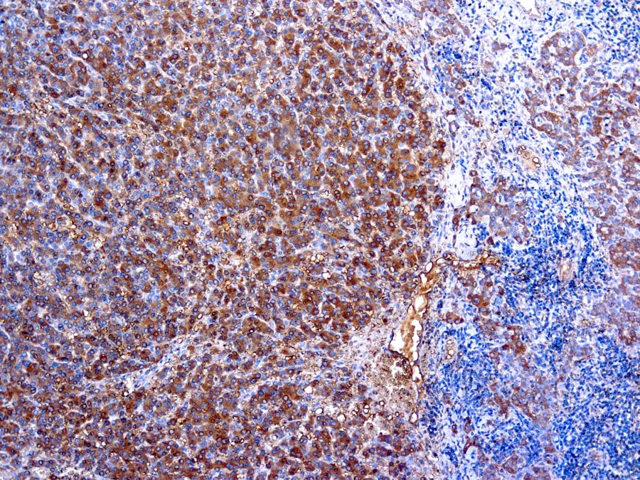 IHC-P analysis of human tonsil tissue using GTX20922 alpha 1 Antitrypsin antibody (ready-to-use). IHC-P analysis of human tonsil tissue using GTX20922 alpha 1 Antitrypsin antibody (ready-to-use).