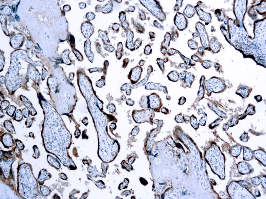 IHC-P analysis of human placenta tissue using GTX20932 hCG beta antibody (ready-to-use). IHC-P analysis of human placenta tissue using GTX20932 hCG beta antibody (ready-to-use).