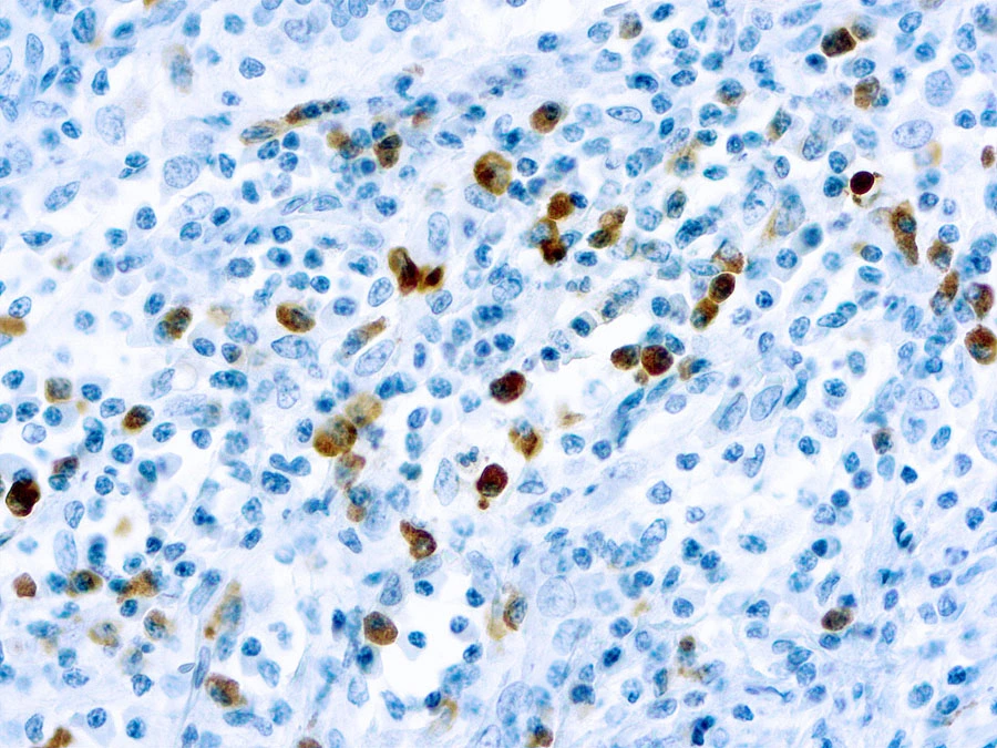 IHC-P analysis of human tonsil tissue using GTX20941 Human lambda Light chain antibody (ready-to-use). IHC-P analysis of human tonsil tissue using GTX20941 Human lambda Light chain antibody (ready-to-use).