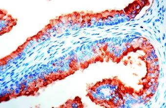 IHC-P analysis of prostate carcinoma using PSA antibody. IHC-P analysis of prostate carcinoma using PSA antibody.