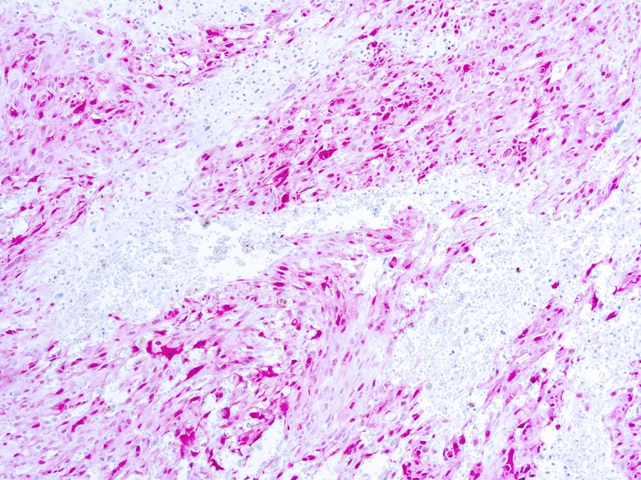 IHC-P analysis of human melanoma tissue using GTX20948 S100 antibody (ready-to-use). IHC-P analysis of human melanoma tissue using GTX20948 S100 antibody (ready-to-use).
