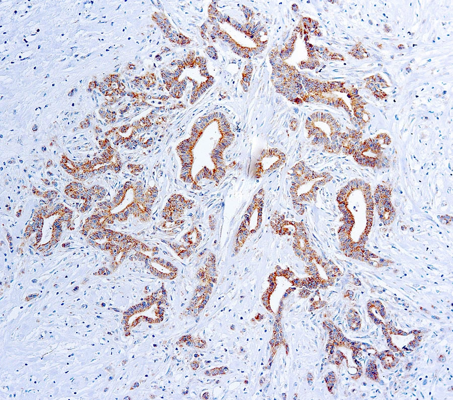 IHC Image using GTX21316 - Detection of VEGF by IHC in Human Angiosarcoma