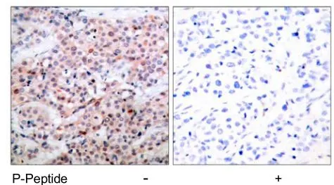 IHC-P analysis of human breast carcinoma tissue using GTX21908 Bcl-2 (phospho Thr56) antibody. IHC-P analysis of human breast carcinoma tissue using GTX21908 Bcl-2 (phospho Thr56) antibody.
