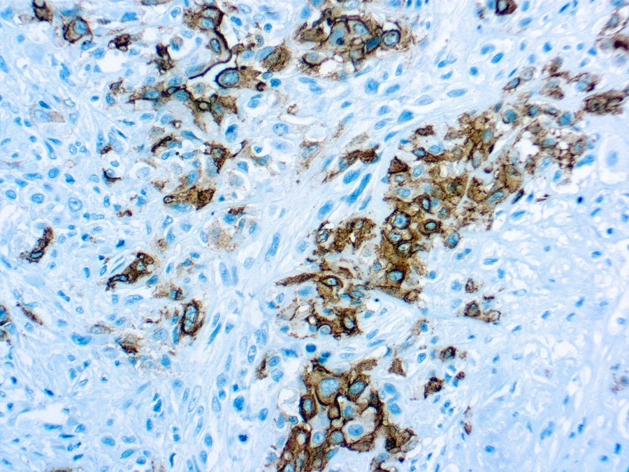 IHC-P analysis of human mesothelioma tissue using GTX22383 Mesothelioma antibody [HBME-1].