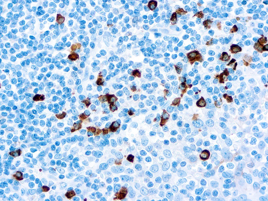 IHC-P analysis of human tonsil tissue using GTX22411 Human IgA antibody. IHC-P analysis of human tonsil tissue using GTX22411 Human IgA antibody.
