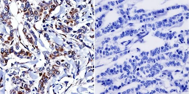 IHC-P analysis of human breast carcinoma tissue using GTX22729 Cytohesin 1 + Cytohesin 2 antibody [6G11]. Left : Primary antibody Right : Negative control without primary antibody Antigen retrieval : heat induced antigen retrieval was performed using 10mM sodium citrate (pH6.0) buffer, microwaved for 8-15 minutes Dilution : 1:300