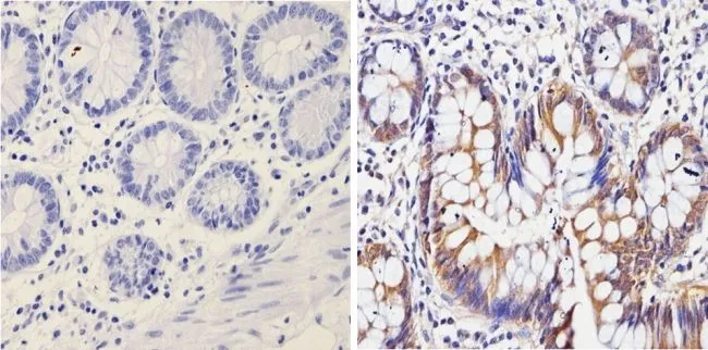 IHC-P analysis of human colon tissue using GTX22785 Galectin 3 antibody [A3A12]. Right : Primary antibody Left : Negative control without primary antibody Antigen retrieval : 10mM sodium citrate (pH 6.0) microwaved for 8-15 min Dilution : 1:100