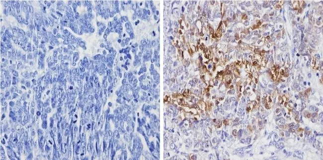 IHC-P analysis of human ovarian carcinoma tissue using GTX22785 Galectin 3 antibody [A3A12]. Right : Primary antibody Left : Negative control without primary antibody Antigen retrieval : 10mM sodium citrate (pH 6.0) microwaved for 8-15 min Dilution : 1:100