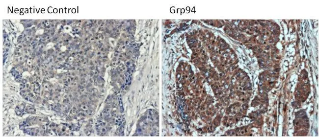 IHC-P analysis of poorly differentiated adenocarcinoma tissue from human colon tissue sections using GTX22791 GRP94 antibody [9G10]. Right : Primary antibody Left : Negative control without primary antibody Antigen retrieval : 10mM sodium citrate (pH 6.0) buffer for 20 minutes at 95oC Dilution : 1:100