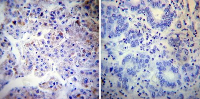IHC-P analysis of human hepatocarcinoma tissue using GTX22798 Calnexin antibody [AF18]. Left : Primary antibody Right : Negative control without primary antibody Antigen retrieval : heat induced antigen retrieval was performed using 10mM sodium citrate (pH6.0) buffer, microwaved for 8-15 minutes Dilution : 1:20