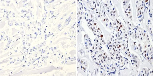 IHC-P analysis of human breast carcinoma tissue using GTX22851 DNMT3B antibody. Right : Primary antibody Left : Negative control without primary antibody Antigen retrieval : 10mM sodium citrate (pH 6.0) microwaved for 8-15 min Dilution : 1:500