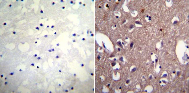 IHC-P analysis of human renal carcinoma tissue using GTX22867 Sodium Potassium ATPase antibody [9-A5]. Antigen retrieval : 10mM sodium citrate followed by microwave treatment for 8-15 minutes. Dilution : 1:10