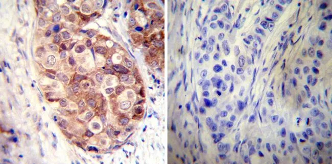 IHC-P analysis of human breast carcinoma tissue using GTX22928 Hsp90 alpha antibody. Left : Primary antibody Right : Negative control without primary antibody Antigen retrieval : heat induced antigen retrieval was performed using 10mM sodium citrate (pH6.0) buffer, microwaved for 8-15 minutes Dilution : 1:50