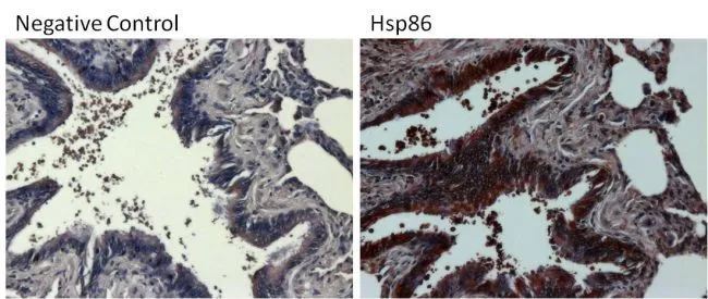 IHC-P analysis of differentiated colon adenocarcinoma tissue from human colon tissue sections using GTX22928 Hsp90 alpha antibody. Left : without primary antibody Right : with primary antibody Antigen retrieval : 10mM sodium citrate (pH 6.0) buffer for 20 minutes at 95oC Dilution : 1:100