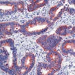 Formalin-fixed, paraffin-embedded human colon carcinoma stained with GTX23127 using peroxidase-conjugate and AEC chromogen. Note cytoplasmic staining of tumor cells.