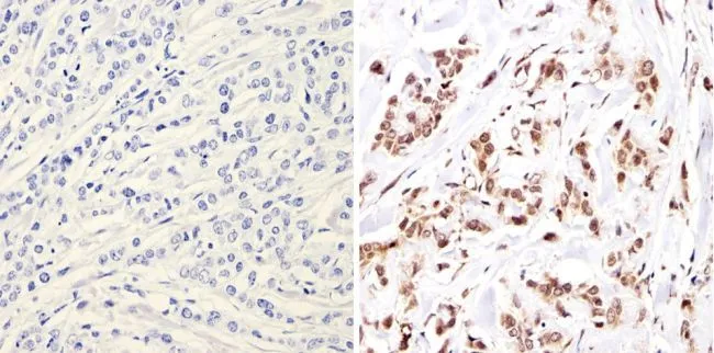 IHC-P analysis of human breast carcinoma tissue using GTX23482 NCOR1 antibody. Right : Primary antibody Left : Negative control without primary antibody Antigen retrieval : 10mM sodium citrate (pH 6.0), microwaved for 8-15 min Dilution : 1:200