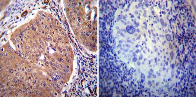 IHC-P analysis of human cervical carcinoma tissue using GTX23529 PMCA2 ATPase antibody.
