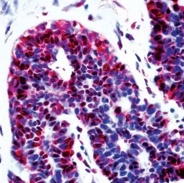IHC Image using GTX23642 - Detection of p12ARF by IHC in Human Cercival Cancer