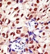 IHC-P analysis of human breast carcinoma using GTX23763 PRMT2 antibody.
