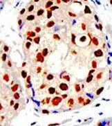 IHC-P analysis of human breast carcinoma using GTX23768 PRMT1 antibody.